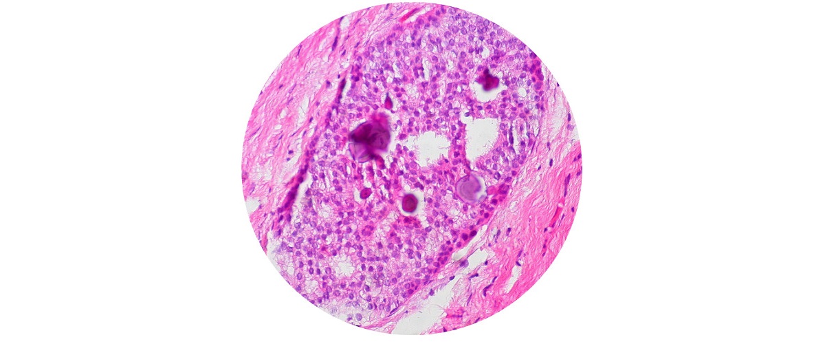 DuctalCarcinoma.jpg